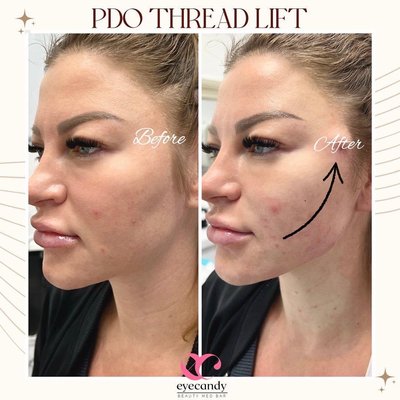 PDO THREADLIFT - Start looking young with PDO thread lift.
PDO thread lifting, a unique inclusion in our aesthetic med bar services for youthful, juvenile, and alluring appearance. Aging is a fact of life; looking at your age is not!
Text 📲: (949)-877-0256
Call 📞: (562)-402-1888
Website 💻: www.eyecandylashandbrowspa.com