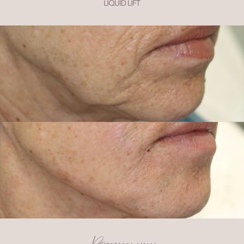 RSMD Medical Aesthetics - Before and After - Laser Hair Removal Near Me - Capitola, California RSMD Medical Aesthetics - Before and After - Laser Hair Removal Near Me - Capitola, California
