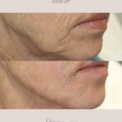 RSMD Medical Aesthetics - Before and After