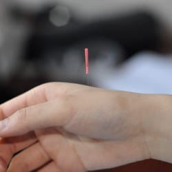 Almond Wellness Centre - Acupuncture