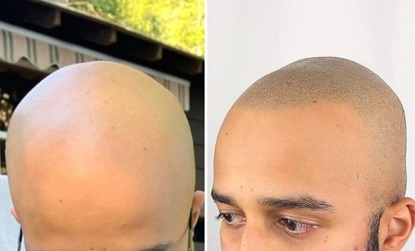Other Treatments (Scalp Micropigmentation, Tattoo Removal, Russian Manicure, Lymph Drainage, Anti-Cellulite Treatment) - We also offer:
Scalp Micropigmentation - Scalp micropigmentation is a procedure in which pigment is injected into the scalp to create the appearance of hair. The pigments used in scalp micropigmentation are usually made from iron oxide, titanium dioxide, or other minerals. The pigments are injected into the upper layers of the skin using a fine needle, and they can be applied to the entire scalp or just to specific areas. Scalp micropigmentation is often used to camouflage hair loss, and it can also be used to create the illusion.
Tattoo Removal - The Saline Acid Tattoo Removal is an effective method of tattoo elimination that has various advantages over traditional laser therapies. The Saline Method is effective on all types of tattoos, regardless of age, color, and location. All grades of tattoos including permanent makeup and “homemade” tattoos are also easily treatable. The saline method is relatively painless in comparison to other methods of removal which can cause blistering or potential scar formation.
Russian Manicure - The Russian manicure technique removes as much skin as possible from the nail area, which leaves more room for polish. This results in a “cleaner”-looking finish and helps to extend the length of time between appointments, as the skin and nail take longer to grow back than with regular manicures.
Lymph Drainage, Anti-Cellulite Treatment - Helping your lymphatic system with things like lymphatic drainage massage can improve its ability to eliminate extra fluid and waste. It also helps lessen swelling in the body and makes cellulite look less noticeable. So, keeping your lymphatic system healthy is essential for controlling both swelling and cellulite. Other Treatments (Scalp Micropigmentation, Tattoo Removal, Russian Manicure, Lymph Drainage, Anti-Cellulite Treatment) - We also offer:
Scalp Micropigmentation - Scalp micropigmentation is a procedure in which pigment is injected into the scalp to create the appearance of hair. The pigments used in scalp micropigmentation are usually made from iron oxide, titanium dioxide, or other minerals. The pigments are injected into the upper layers of the skin using a fine needle, and they can be applied to the entire scalp or just to specific areas. Scalp micropigmentation is often used to camouflage hair loss, and it can also be used to create the illusion.
Tattoo Removal - The Saline Acid Tattoo Removal is an effective method of tattoo elimination that has various advantages over traditional laser therapies. The Saline Method is effective on all types of tattoos, regardless of age, color, and location. All grades of tattoos including permanent makeup and “homemade” tattoos are also easily treatable. The saline method is relatively painless in comparison to other methods of removal which can cause blistering or potential scar formation.
Russian Manicure - The Russian manicure technique removes as much skin as possible from the nail area, which leaves more room for polish. This results in a “cleaner”-looking finish and helps to extend the length of time between appointments, as the skin and nail take longer to grow back than with regular manicures.
Lymph Drainage, Anti-Cellulite Treatment - Helping your lymphatic system with things like lymphatic drainage massage can improve its ability to eliminate extra fluid and waste. It also helps lessen swelling in the body and makes cellulite look less noticeable. So, keeping your lymphatic system healthy is essential for controlling both swelling and cellulite.
