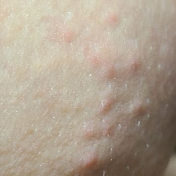 Comfort Inn & Suites - Very clearly bed bug bites - Hotels Near Me - Mount Pocono, Pennsylvania