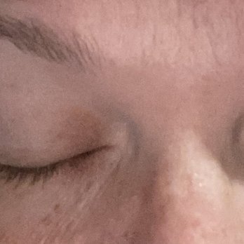 Arch 2 Arch - Scabs on eyelids - Skin Care Near Me - Memphis, Tennessee Arch 2 Arch - Scabs on eyelids - Skin Care Near Me - Memphis, Tennessee