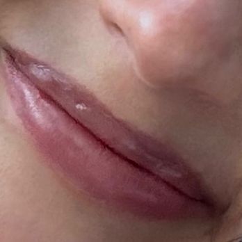 Plump Medspa - Indents/scars - Medical Spas Near Me - Beaverton, Oregon