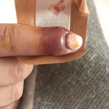 New York Nails - 2weeks after it's gotten worse. - Nail Salons Near Me - South Gate, California New York Nails - 2weeks after it's gotten worse. - Nail Salons Near Me - South Gate, California