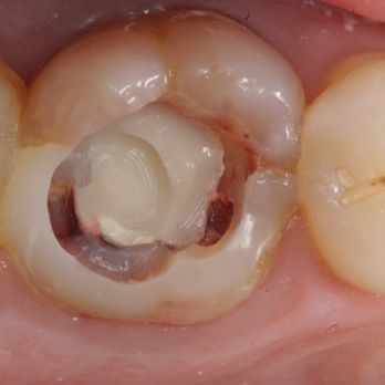 Greg Vigoren, DDS - This is a macro photo of my tooth thanks to the doctor that I have equipment through which you can see a microcrack - Oral Surgeons Near Me - Newport Beach, California Greg Vigoren, DDS - This is a macro photo of my tooth thanks to the doctor that I have equipment through which you can see a microcrack - Oral Surgeons Near Me - Newport Beach, California