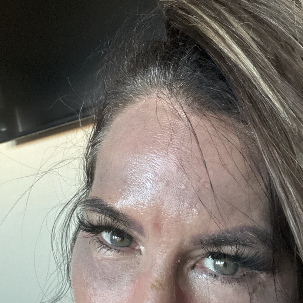LaserAway - It has definitely improved with the VI Peel - Tattoo Removal Near Me - Lone Tree, Colorado LaserAway - It has definitely improved with the VI Peel - Tattoo Removal Near Me - Lone Tree, Colorado