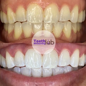 Teeth Whitening Lab - Teeth Whitening - Teeth Whitening Near Me - Long Beach, California Teeth Whitening Lab - Teeth Whitening - Teeth Whitening Near Me - Long Beach, California