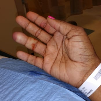 Cindy's Nails - PARONYCHIA, a nail infection from manicurist using dirty tools. She had the nerve to say it was a food allergy... - Nail Salons Near Me - Conyers, Georgia