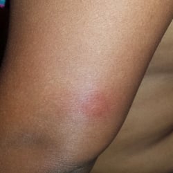 Bed bug bite