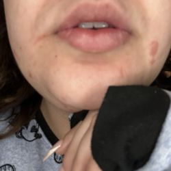 Jelly Pop Nails - Burn marks day after 2/12/24 AM