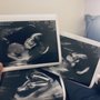 PRENATAL DIAGNOSIS OF NORTHERN CALIFORNIA