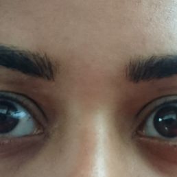 Immediately "after"! They got thinner and more natural looking after healing for a couple of weeks. Immediately "after"! They got thinner and more natural looking after healing for a couple of weeks.