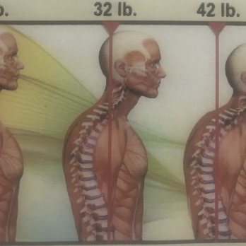 Benson Chiropractic - Scoliosis - Benson Chiropractic | San Francisco, CA 94118 - Chiropractors Near Me - San Francisco, California