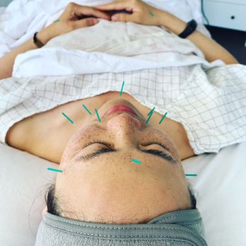 SmartPoint Acupuncture - Facial rejuvenation treatment - Acupuncture Near Me - San Jose, California