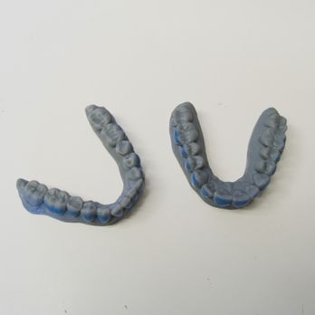 Ben Yount, DDS - Models printed out form 3D scanning. - General Dentistry Near Me - San Mateo, California Ben Yount, DDS - Models printed out form 3D scanning. - General Dentistry Near Me - San Mateo, California