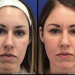 Before and after BBL and Halo laser treatment. The after is 7 days later.