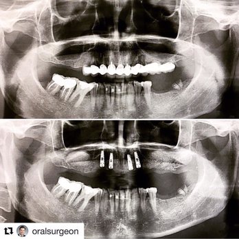 Pristine Oral & Maxillofacial Surgery - Full upper arch extractions with bilateral sinus lifts and 4 anterior implants - Oral Surgeons Near Me - Brooklyn, New York Pristine Oral & Maxillofacial Surgery - Full upper arch extractions with bilateral sinus lifts and 4 anterior implants - Oral Surgeons Near Me - Brooklyn, New York