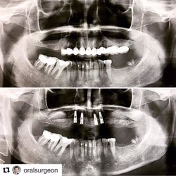 Pristine Oral & Maxillofacial Surgery - Full upper arch extractions with bilateral sinus lifts and 4 anterior implants