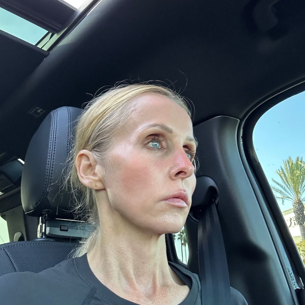 Daxxify: Forehead, hairline, crow's feet, jawline, and neck. 1.5 weeks out. Love the results! Daxxify: Forehead, hairline, crow's feet, jawline, and neck. 1.5 weeks out. Love the results!