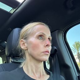 Daxxify: Forehead, hairline, crow's feet, jawline, and neck. 1.5 weeks out. Love the results! Daxxify: Forehead, hairline, crow's feet, jawline, and neck. 1.5 weeks out. Love the results!
