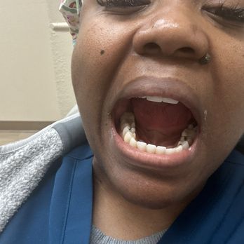 West Coast Dental of Paramount - New crown tooth 18 . - Pediatric Dentists Near Me - Paramount, California West Coast Dental of Paramount - New crown tooth 18 . - Pediatric Dentists Near Me - Paramount, California