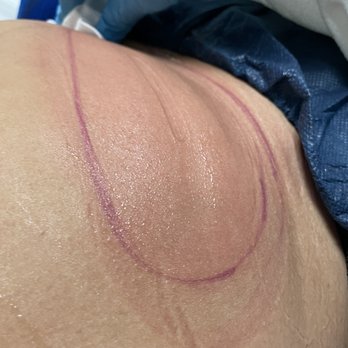 LaserAway - Tattoo Removal Near Me - Houston, Texas