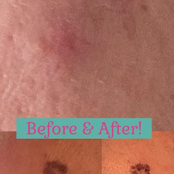 Foxy Laser - Laser - Medical Spas Near Me - Denver, Colorado