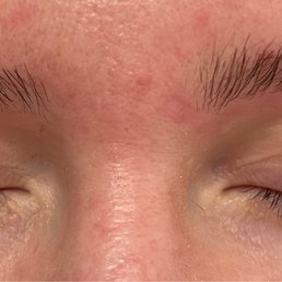 Left brow (right in the photo) is completely shortened and I'm not able to have full eyebrows, the hair is short and stick like needles. Left brow (right in the photo) is completely shortened and I'm not able to have full eyebrows, the hair is short and stick like needles.