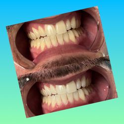 Smile Brite Teeth Whitening - Book your transformation Today!