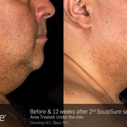The Laser Spa at Sonoma - SculpSure Under The Chin
