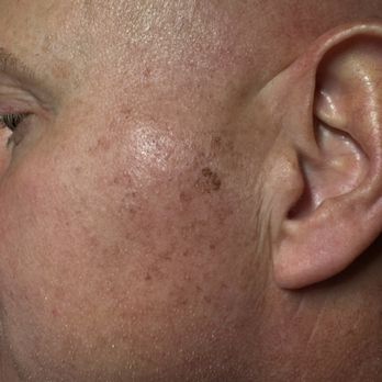 MPZ Dermatology - Before IPL laser for brown spots. - Dermatologists Near Me - Corona, California
