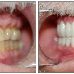 Origin Dental - Patient is a long time, heavy grinder w/ eroded enamel. We treated the patient with full porcelain crowns. He was extremely happy!