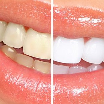 Yuri Krainov, DDS - Whitening done in our office - General Dentistry Near Me - Brooklyn, New York Yuri Krainov, DDS - Whitening done in our office - General Dentistry Near Me - Brooklyn, New York