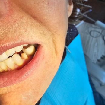 Verdugo Hills Dental Group - This is my old tooth after Dr. Hakopyan did the prep work. - General Dentistry Near Me - Glendale, California Verdugo Hills Dental Group - This is my old tooth after Dr. Hakopyan did the prep work. - General Dentistry Near Me - Glendale, California
