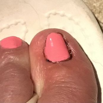 Lovely Nails - As you can see swollen, dried blood and painful. Fearful of an infection at this point. - Nail Salons Near Me - Humble, Texas Lovely Nails - As you can see swollen, dried blood and painful. Fearful of an infection at this point. - Nail Salons Near Me - Humble, Texas