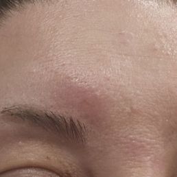 2 days later and my face is a mess