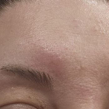 Nu Face For U - 2 days later and my face is a mess - Medical Spas Near Me - Upland, California Nu Face For U - 2 days later and my face is a mess - Medical Spas Near Me - Upland, California