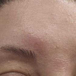 Nu Face For U - 2 days later and my face is a mess