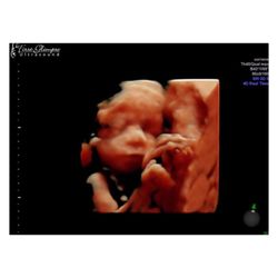 First Glimpse Ultrasound