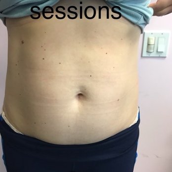 Eye Candy Body Sculpting - After 9 sessions - Body Contouring Near Me - Corona, California