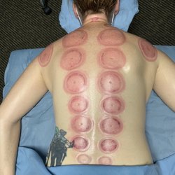 The Art of Massage - Cupping