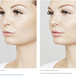 Timeless Beauty Aesthetics - Restylane