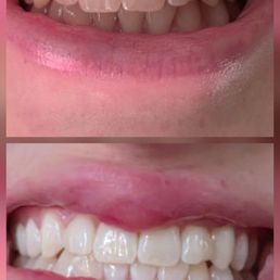 Before and after photos of the Zoom teeth whitening procedure. Before and after photos of the Zoom teeth whitening procedure.