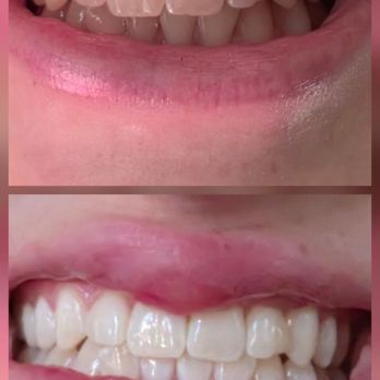 Gold Coast Dental - Before and after photos of the Zoom teeth whitening procedure. - Orthodontists Near Me - Azusa, California Gold Coast Dental - Before and after photos of the Zoom teeth whitening procedure. - Orthodontists Near Me - Azusa, California