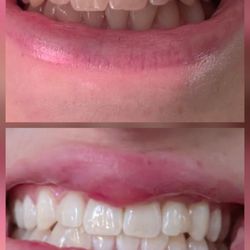 Gold Coast Dental Azuza - Before and after photos of the Zoom teeth whitening procedure.