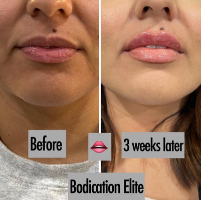 Lips and Face Balance - Before & Afters - Bodication Elite LLC is your vacation place day spa here to serve the Dallas/Ft Worth Area. You are in the right place if you have been looking for Post Op care after cosmetic surgery, we have 5 years of experience. Our services don’t stop there as we offer many other services including body sculpting, injectables, self-care and so much more. So if you are ready to trust us with your body then continue to check out the website and get ready to get snatch and discover the new you! Lips and Face Balance - Before & Afters - Bodication Elite LLC is your vacation place day spa here to serve the Dallas/Ft Worth Area. You are in the right place if you have been looking for Post Op care after cosmetic surgery, we have 5 years of experience. Our services don’t stop there as we offer many other services including body sculpting, injectables, self-care and so much more. So if you are ready to trust us with your body then continue to check out the website and get ready to get snatch and discover the new you!