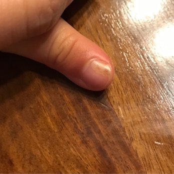 Learning Tree Montessori of Arcadia - My daughter's thumb nail after a month from the accident - Child Care & Day Care Near Me - Arcadia, California Learning Tree Montessori of Arcadia - My daughter's thumb nail after a month from the accident - Child Care & Day Care Near Me - Arcadia, California