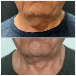 Iris Beauty Solution - Before and After Body FX treatment