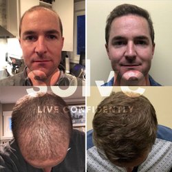 Solve Clinics - FUE (1800 grafts) + 5 PRP
Solve is the highest rated hair loss clinic in Chicago. Contact us for a free hair loss consultation and price.